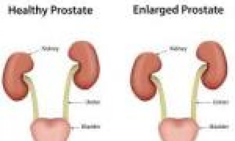 No man in Bolgatanga has prostate size above 40grams-research reveals