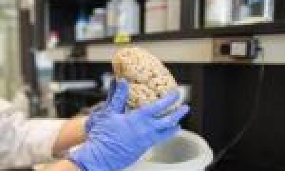 Research findings could lead to treatment for deadly brain cancer