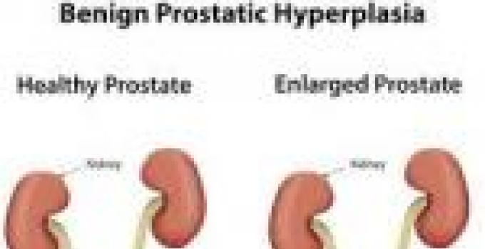 No man in Bolgatanga has prostate size above 40grams-research reveals